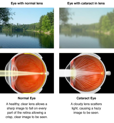 Normal Eye vs Cataract Eye
