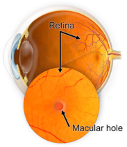 Macular Hole Diagram