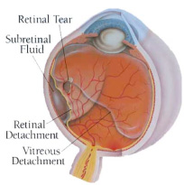 Retinal Detachment Diagram